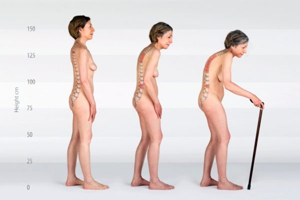 Osteoporoza