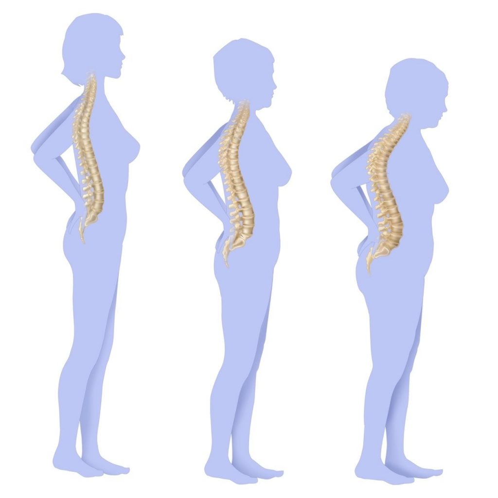 Osteoporoza